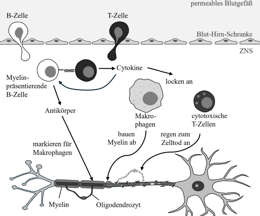 Schematische Darstellung: Immunzellen (B‑Zellen, T‑Zellen, Makrophagen) greifen Myelin und Oligodendrozyten im Zentralnervensystem an.